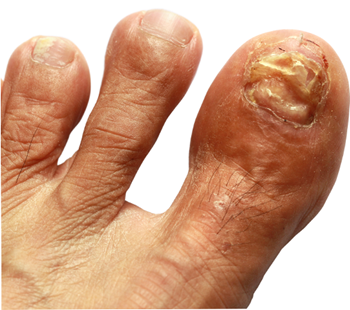 ToeFX treatment results