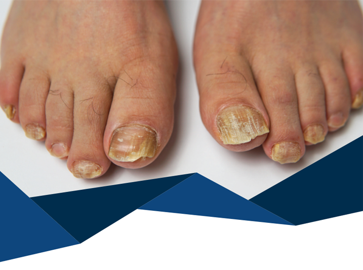 ToeFX nail fungus treatment