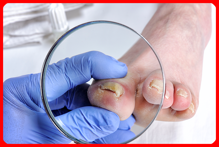 Toenail fungus consultation